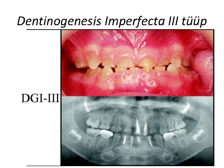 Dentinogenesis Imperfecta III tüüp 