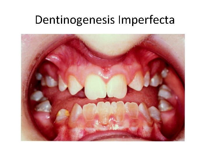 Dentinogenesis Imperfecta 