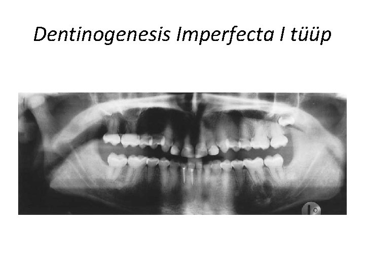 Dentinogenesis Imperfecta I tüüp 