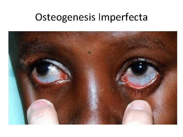 Osteogenesis Imperfecta 