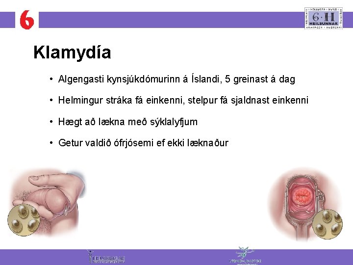 Klamydía • Algengasti kynsjúkdómurinn á Íslandi, 5 greinast á dag • Helmingur stráka fá