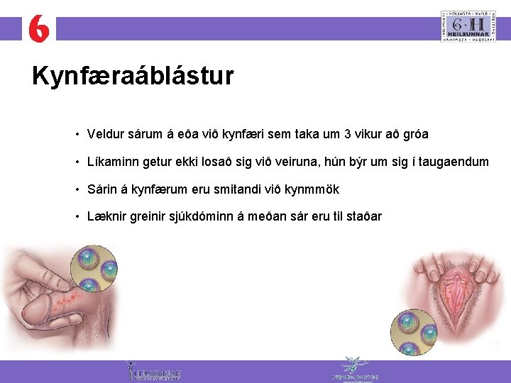 Kynfæraáblástur • Veldur sárum á eða við kynfæri sem taka um 3 vikur að