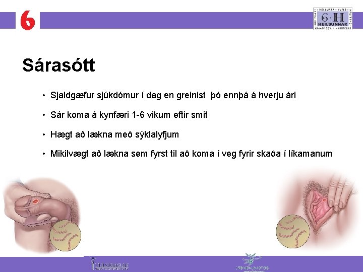 Sárasótt • Sjaldgæfur sjúkdómur í dag en greinist þó ennþá á hverju ári •