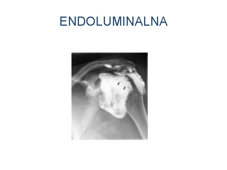 ENDOLUMINALNA 