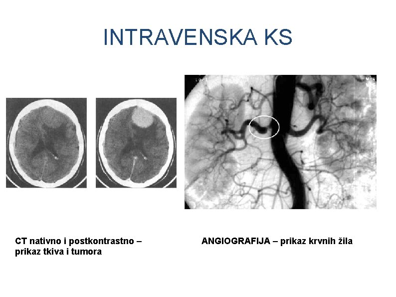 INTRAVENSKA KS CT nativno i postkontrastno – prikaz tkiva i tumora ANGIOGRAFIJA – prikaz