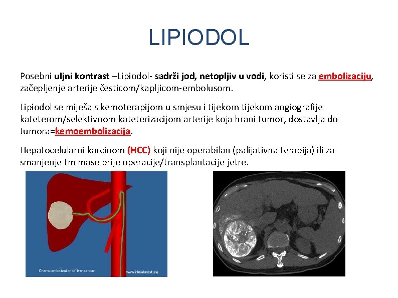 LIPIODOL Posebni uljni kontrast –Lipiodol- sadrži jod, netopljiv u vodi, koristi se za embolizaciju,