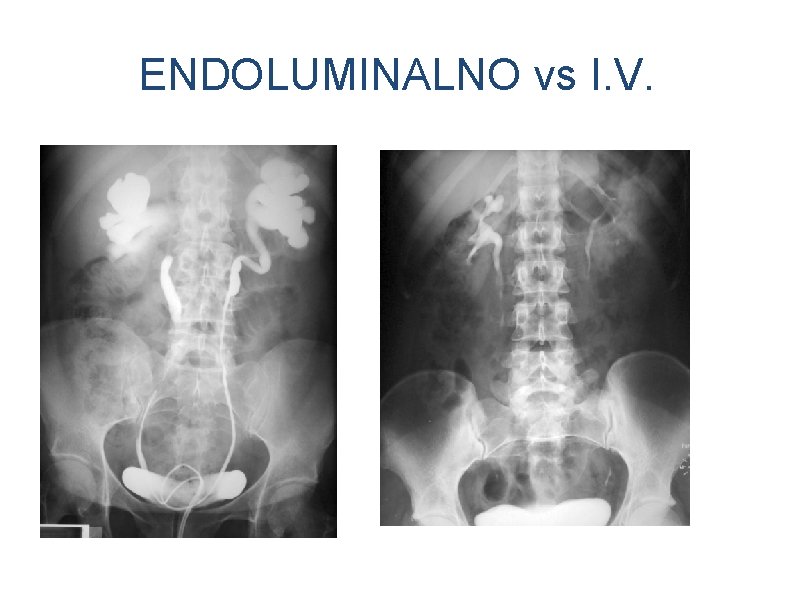 ENDOLUMINALNO vs I. V. 