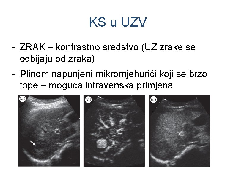 KS u UZV - ZRAK – kontrastno sredstvo (UZ zrake se odbijaju od zraka)