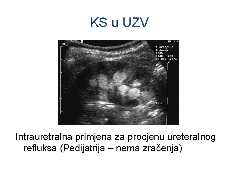 KS u UZV Intrauretralna primjena za procjenu ureteralnog refluksa (Pedijatrija – nema zračenja) 