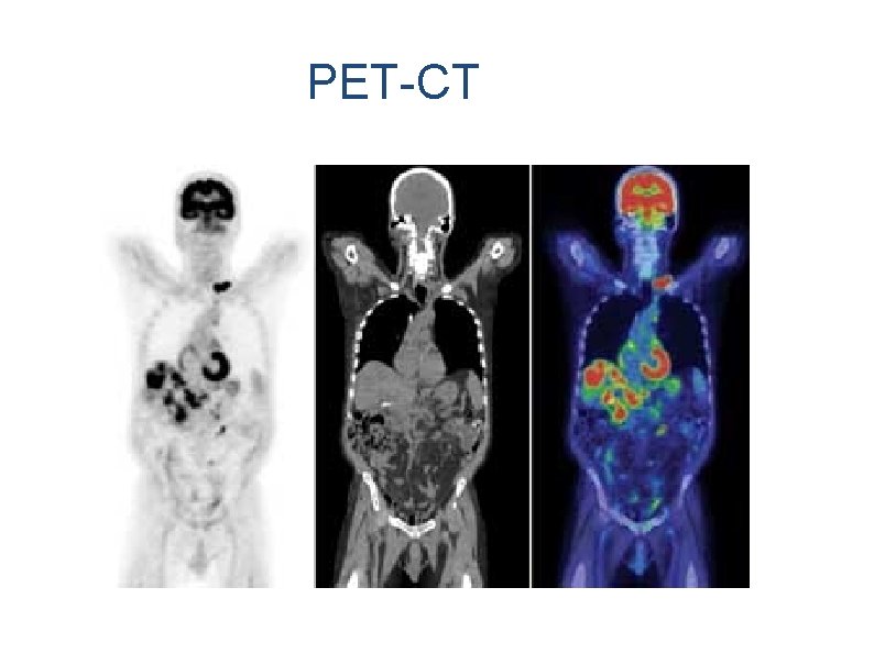 PET-CT 