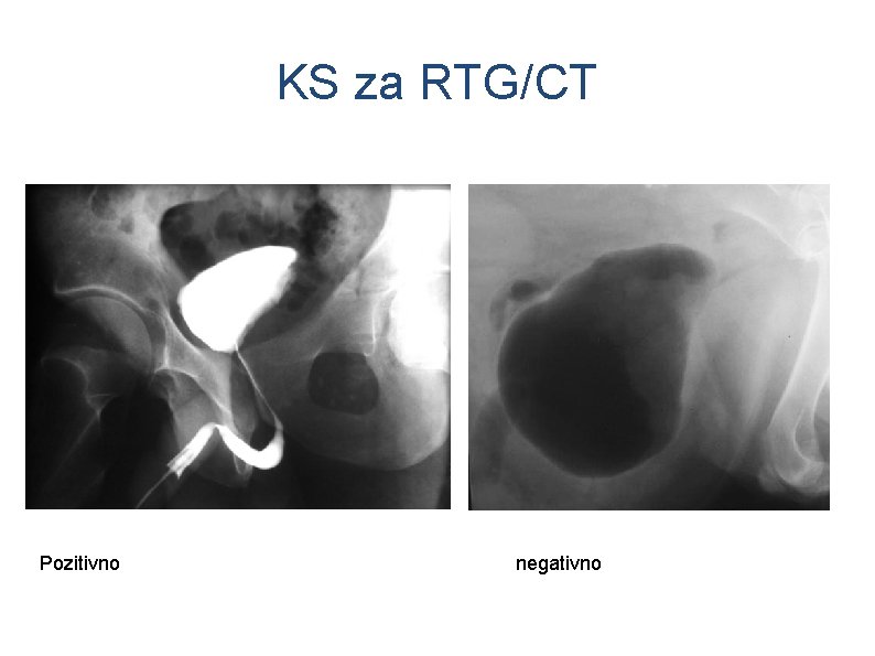 KS za RTG/CT Pozitivno negativno 