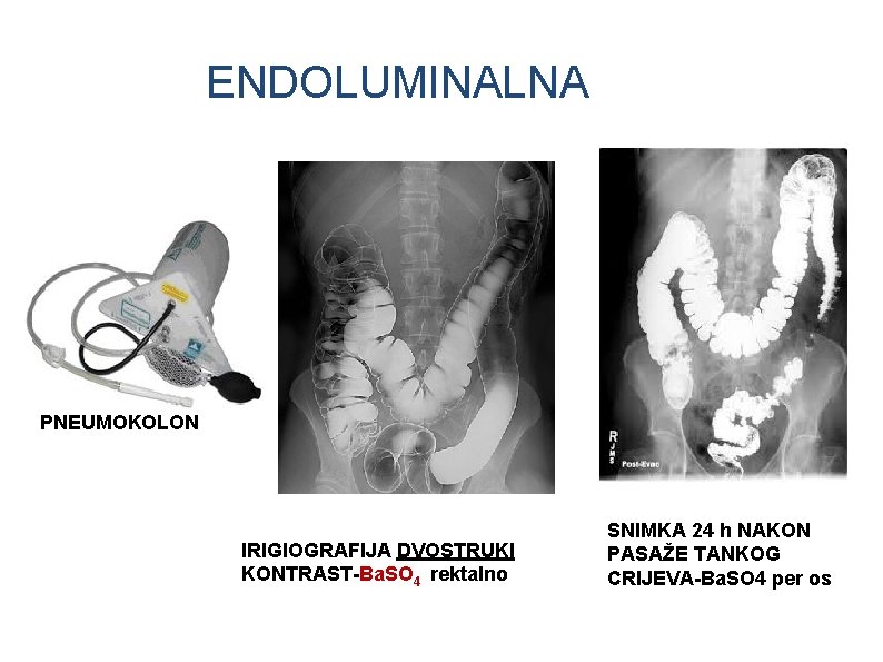 ENDOLUMINALNA PNEUMOKOLON IRIGIOGRAFIJA DVOSTRUKI KONTRAST-Ba. SO 4 rektalno SNIMKA 24 h NAKON PASAŽE TANKOG
