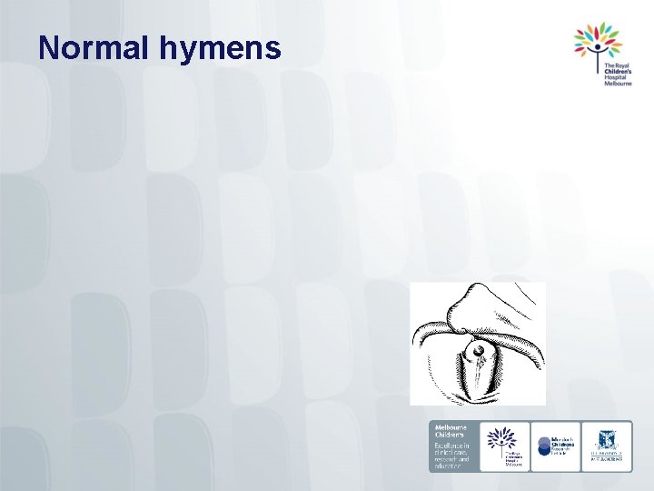 Normal hymens 