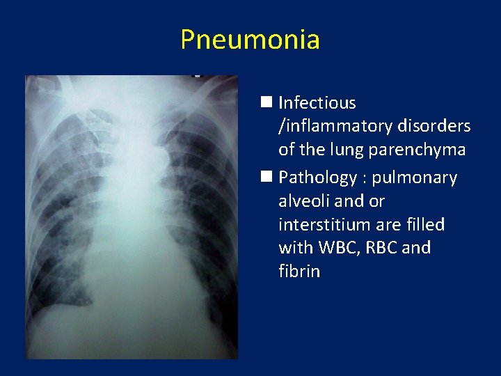 Pneumonia n Infectious /inflammatory disorders of the lung parenchyma n Pathology : pulmonary alveoli