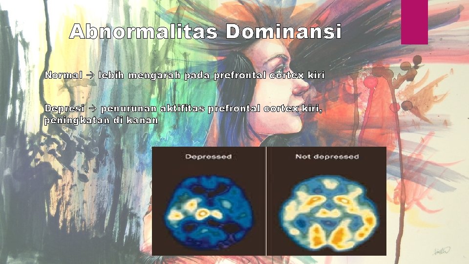 Abnormalitas Dominansi Normal lebih mengarah pada prefrontal cortex kiri Depresi penurunan aktifitas prefrontal cortex