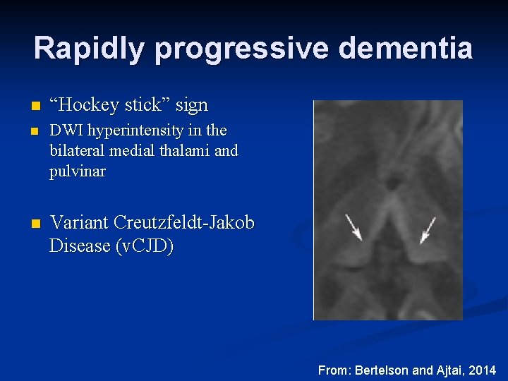 Rapidly progressive dementia n “Hockey stick” sign n DWI hyperintensity in the bilateral medial