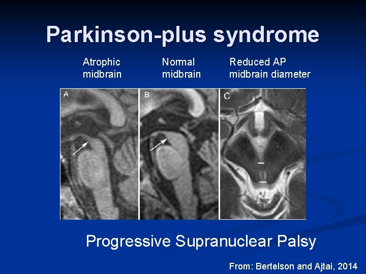 Parkinson-plus syndrome Atrophic midbrain Normal midbrain Reduced AP midbrain diameter Progressive Supranuclear Palsy From: