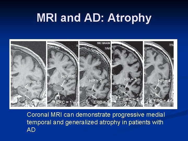 MRI and AD: Atrophy Coronal MRI can demonstrate progressive medial temporal and generalized atrophy