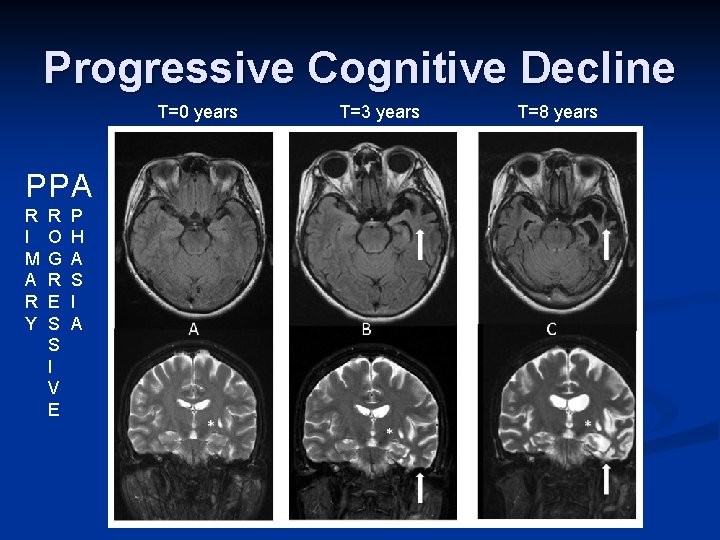 Progressive Cognitive Decline T=0 years PP A R I M A R Y R