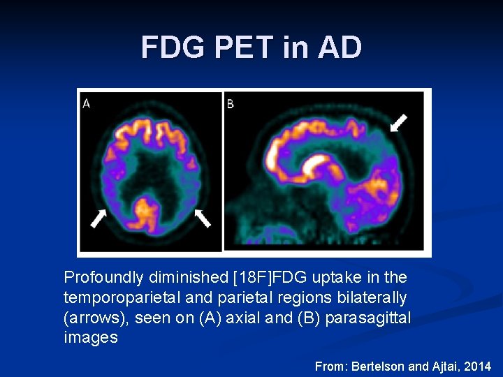 FDG PET in AD Profoundly diminished [18 F]FDG uptake in the temporoparietal and parietal