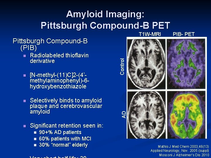 Amyloid Imaging: Pittsburgh Compound-B PET T 1 W-MRI Radiolabeled thioflavin derivative n [N-methyl-(11)C]2 -(4’methylaminophenyl)-6