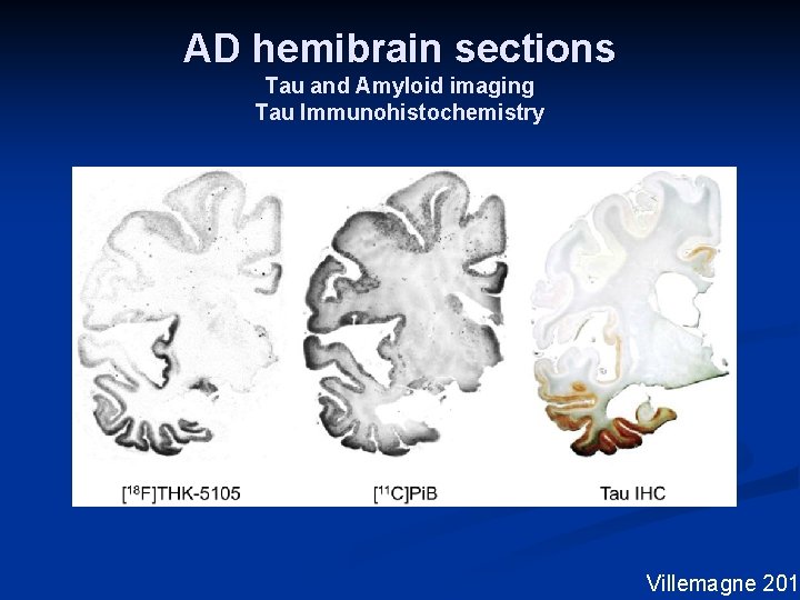 AD hemibrain sections Tau and Amyloid imaging Tau Immunohistochemistry Villemagne 2014 