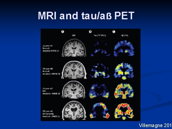 MRI and tau/aẞ PET Villemagne 2015 