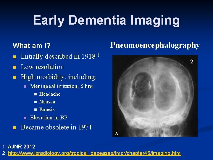 Early Dementia Imaging What am I? n Initially described in 1918 1 n Low