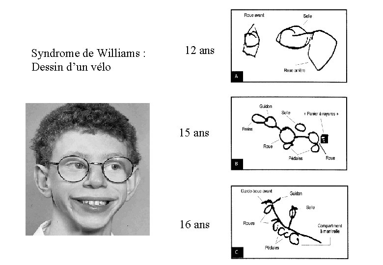 Syndrome de Williams : Dessin d’un vélo 12 ans 15 ans 16 ans 