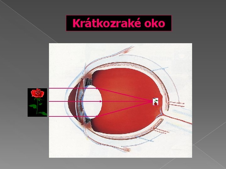 Krátkozraké oko 