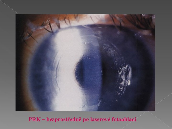 PRK – bezprostředně po laserové fotoablaci 