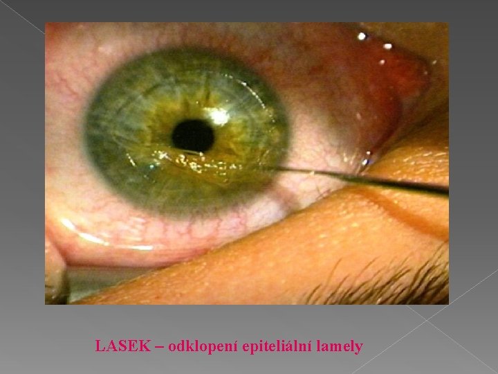 LASEK – odklopení epiteliální lamely 