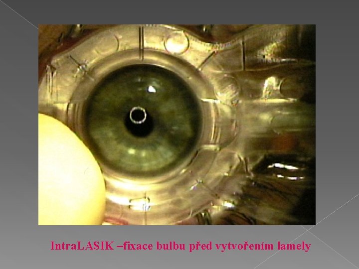 Intra. LASIK –fixace bulbu před vytvořením lamely 