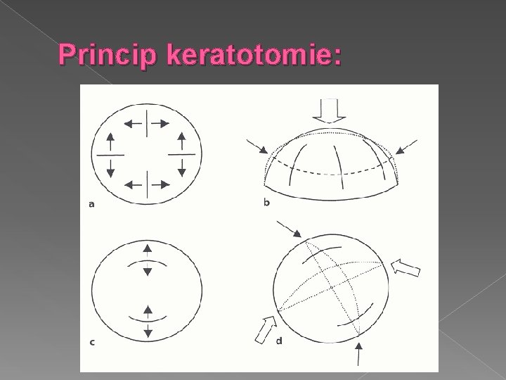 Princip keratotomie: 