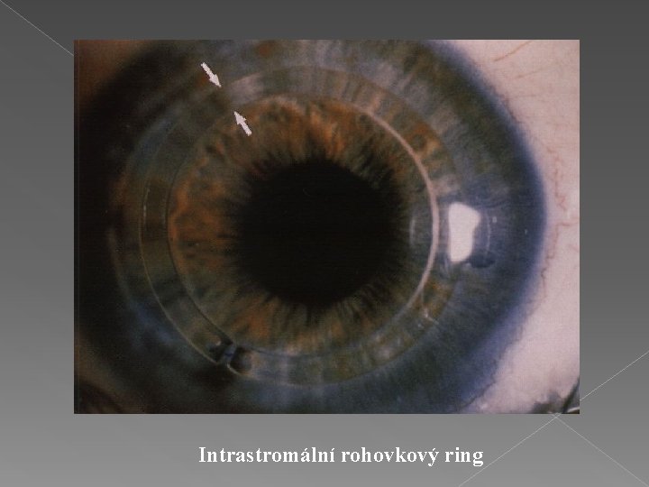 Intrastromální rohovkový ring 