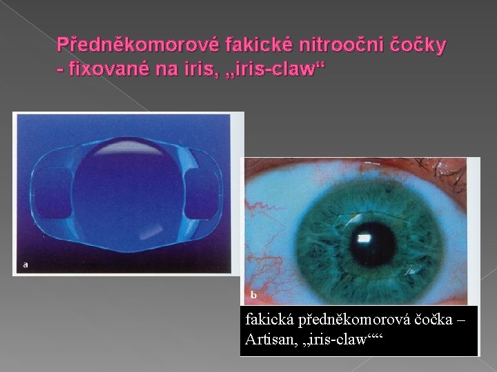 Předněkomorové fakické nitrooční čočky - fixované na iris, „iris-claw“ fakická předněkomorová čočka – Artisan,