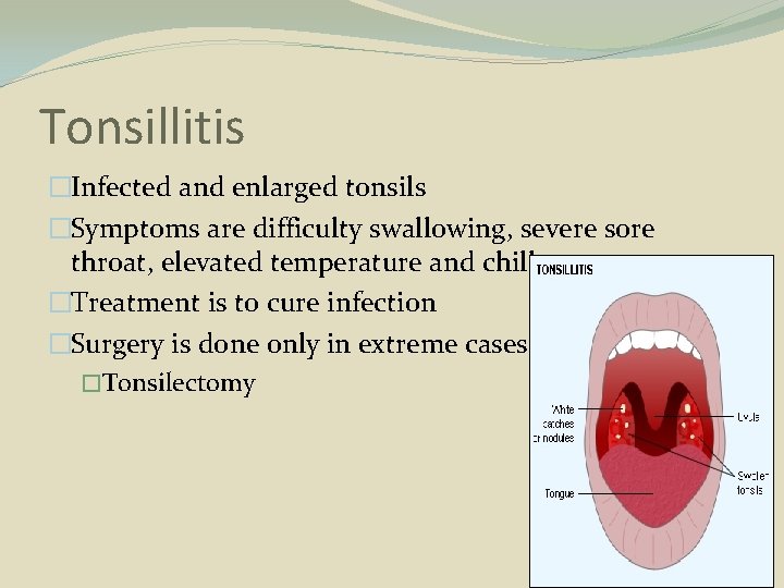 Tonsillitis �Infected and enlarged tonsils �Symptoms are difficulty swallowing, severe sore throat, elevated temperature