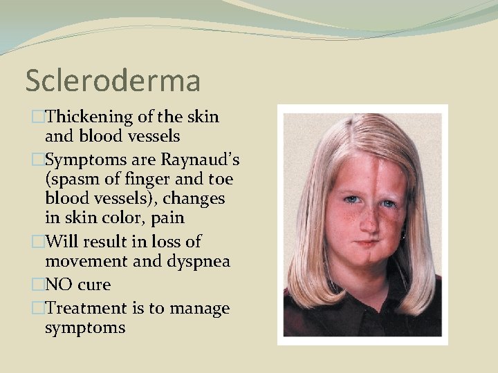 Scleroderma �Thickening of the skin and blood vessels �Symptoms are Raynaud’s (spasm of finger