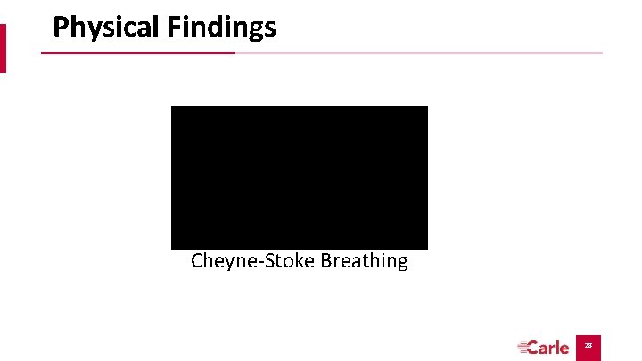 Physical Findings Cheyne-Stoke Breathing 28 