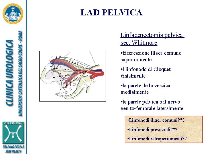 LAD PELVICA Linfadenectomia pelvica sec. Whitmore • biforcazione iliaca comune superiormente • l linfonodo
