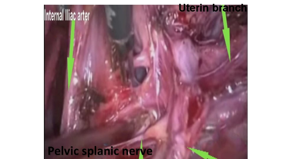 Uterin branch Pelvic splanic nerve 