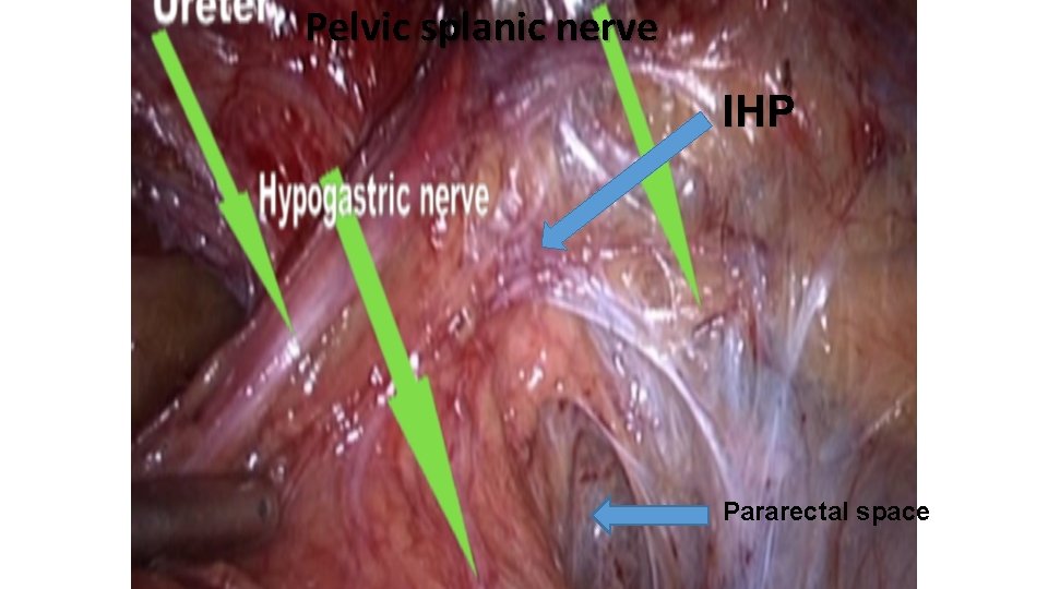 Pelvic splanic nerve IHP Pararectal space 