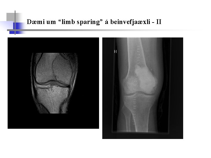 Dæmi um “limb sparing” á beinvefjaæxli - II 