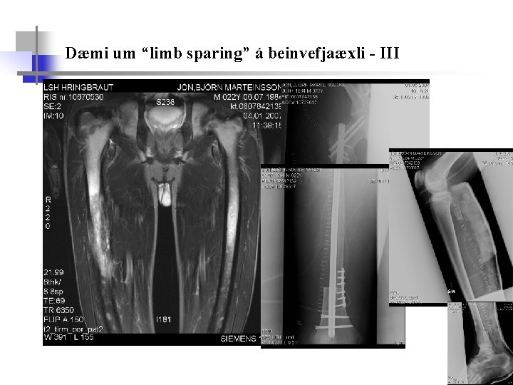 Dæmi um “limb sparing” á beinvefjaæxli - III 