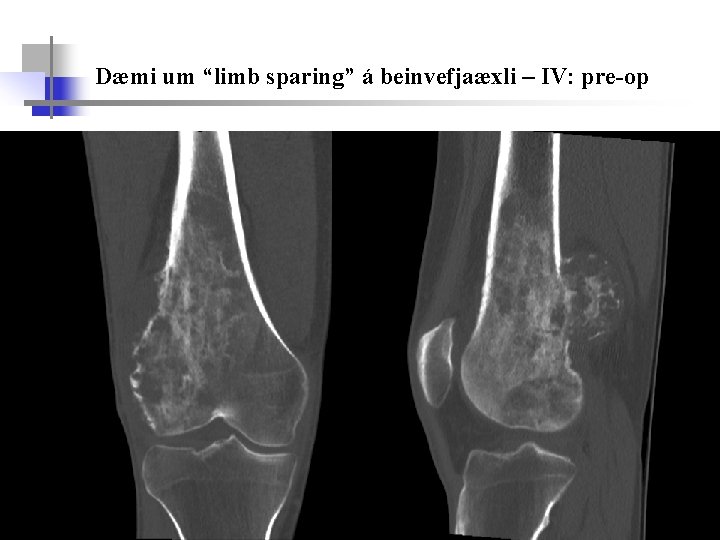 Dæmi um “limb sparing” á beinvefjaæxli – IV: pre-op 