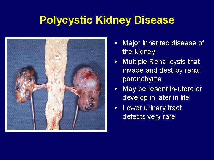 Polycystic Kidney Disease • Major inherited disease of the kidney • Multiple Renal cysts Polycystic Kidney Disease • Major inherited disease of the kidney • Multiple Renal cysts