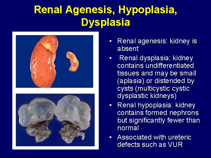 Renal Agenesis, Hypoplasia, Dysplasia • Renal agenesis: kidney is absent • Renal dysplasia: kidney Renal Agenesis, Hypoplasia, Dysplasia • Renal agenesis: kidney is absent • Renal dysplasia: kidney