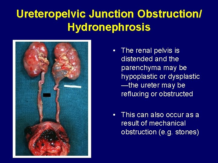 Ureteropelvic Junction Obstruction/ Hydronephrosis • The renal pelvis is distended and the parenchyma may Ureteropelvic Junction Obstruction/ Hydronephrosis • The renal pelvis is distended and the parenchyma may