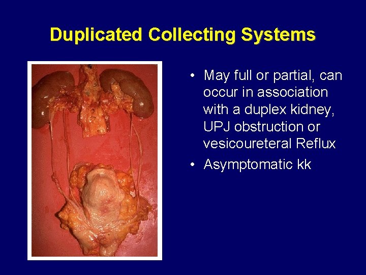 Duplicated Collecting Systems • May full or partial, can occur in association with a Duplicated Collecting Systems • May full or partial, can occur in association with a