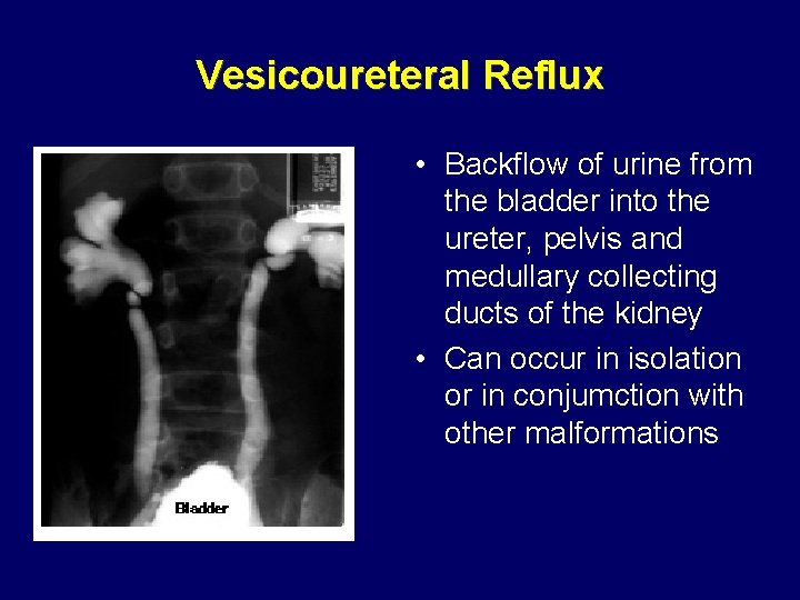 Vesicoureteral Reflux • Backflow of urine from the bladder into the ureter, pelvis and Vesicoureteral Reflux • Backflow of urine from the bladder into the ureter, pelvis and
